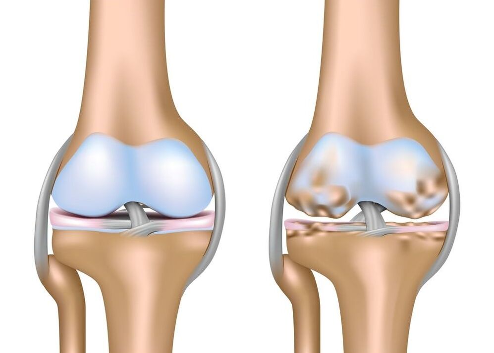 Aggravation de l'arthrose des articulations