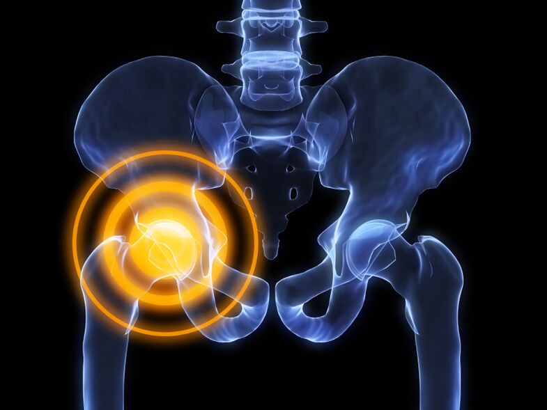 Arthrose de la hanche